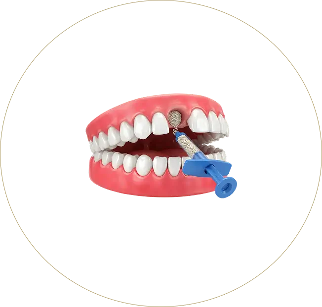 A 3D medical illustration showing a dental bone grafting procedure. A blue syringe is injecting granular bone graft material into an empty tooth socket in the upper jaw to preserve the alveolar ridge after an extraction.