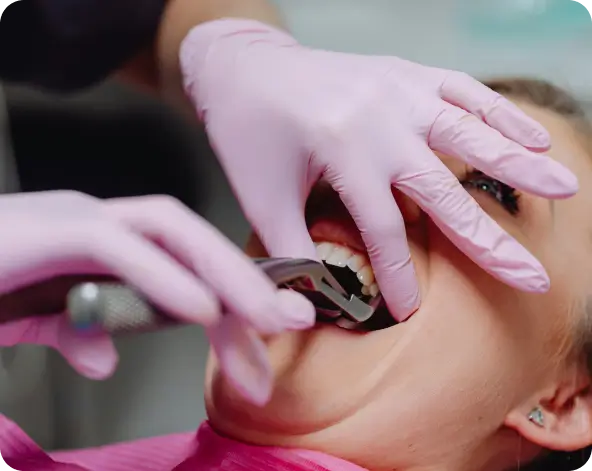 A dentist performing a surgical tooth extraction with specialized dental forceps at Issa Dental Group.