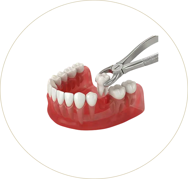 A 3D medical illustration showing a molar being professionally extracted from the lower jaw using dental forceps at Issa Dental Group.
