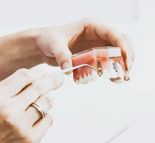 Detailed anatomical model of a human jaw showing the titanium post and crown of a dental implant, used during patient consultations for restorative dentistry.