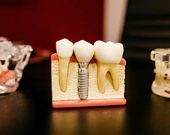 Visual guide to dental implant components at Issa Dental Group, featuring the internal screw-retained post and the aesthetic crown restoration.