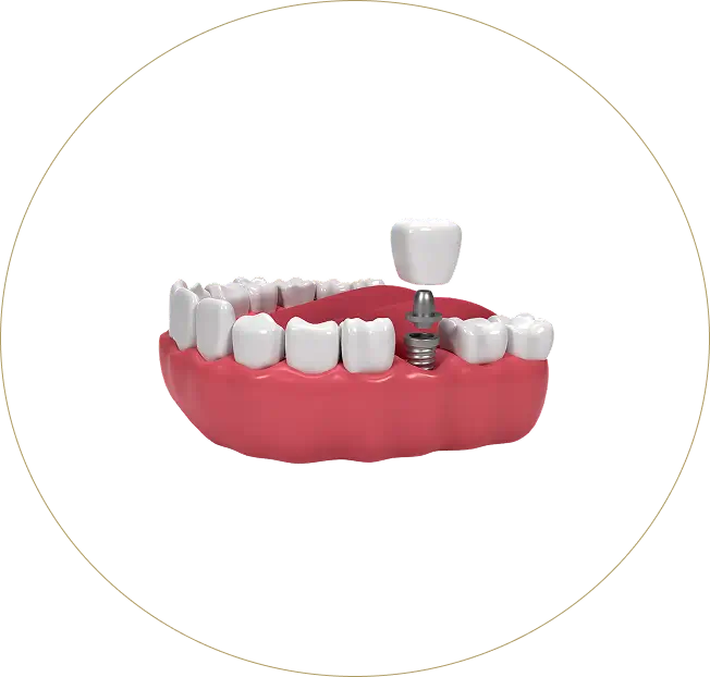 Professional 3D rendering of the dental implant process at Issa Dental Group, illustrating a secure and aesthetic tooth replacement.
