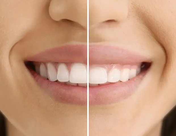Split image showing a before and after comparison of a patient’s smile following a gum graft procedure to treat receding gums