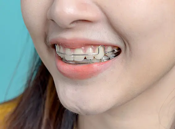 Professional dental retainer for teeth alignment maintenance at Issa Dental Group.
