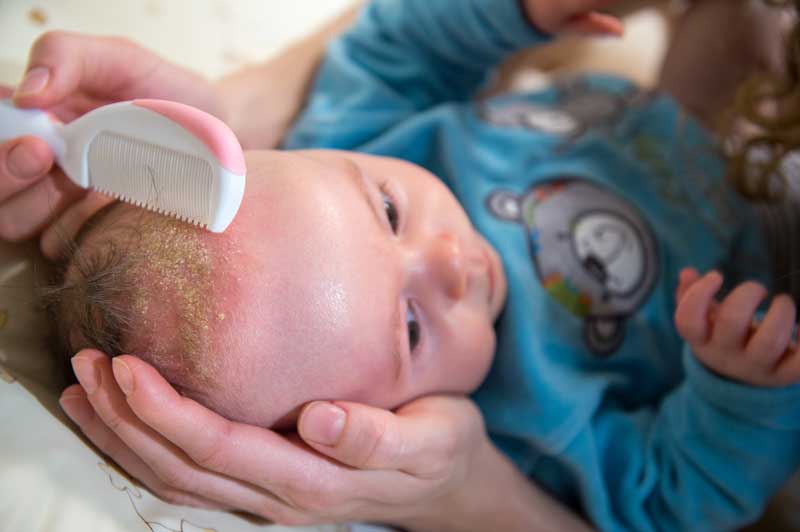 Baby having their scalp lightly brushed by a person with a special comb to remove loose crust.