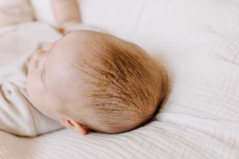 A baby with red hair and lying in a white cot with non infectious cradle cap.