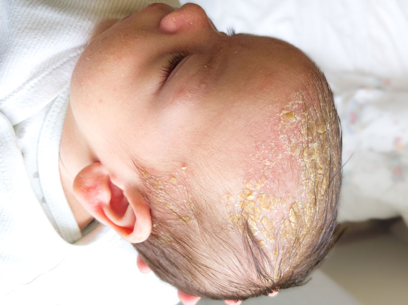 A baby being held to show what cradle cap looks like with scaly yellow patches on their scalp.