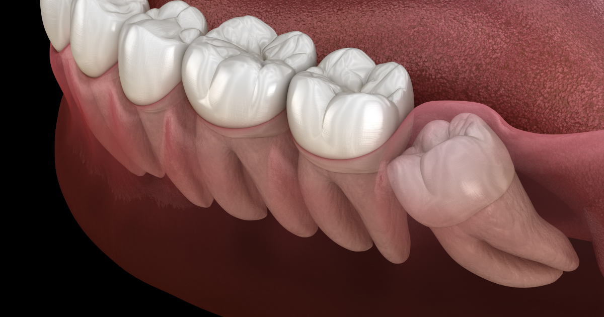 Impacted wisdom teeth