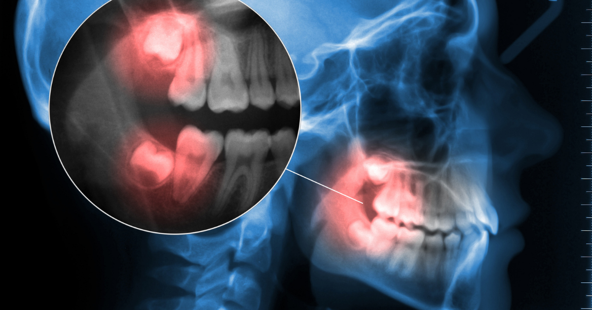 Impacted wisdom teeth symptoms