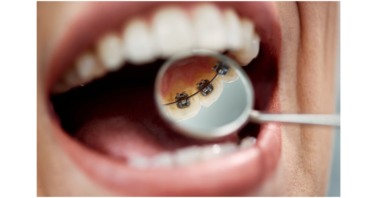 Lingual braces