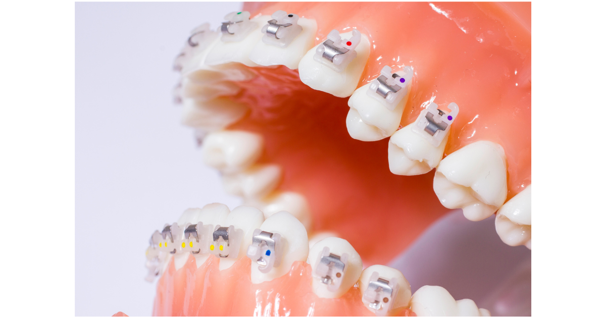 Self-ligating braces