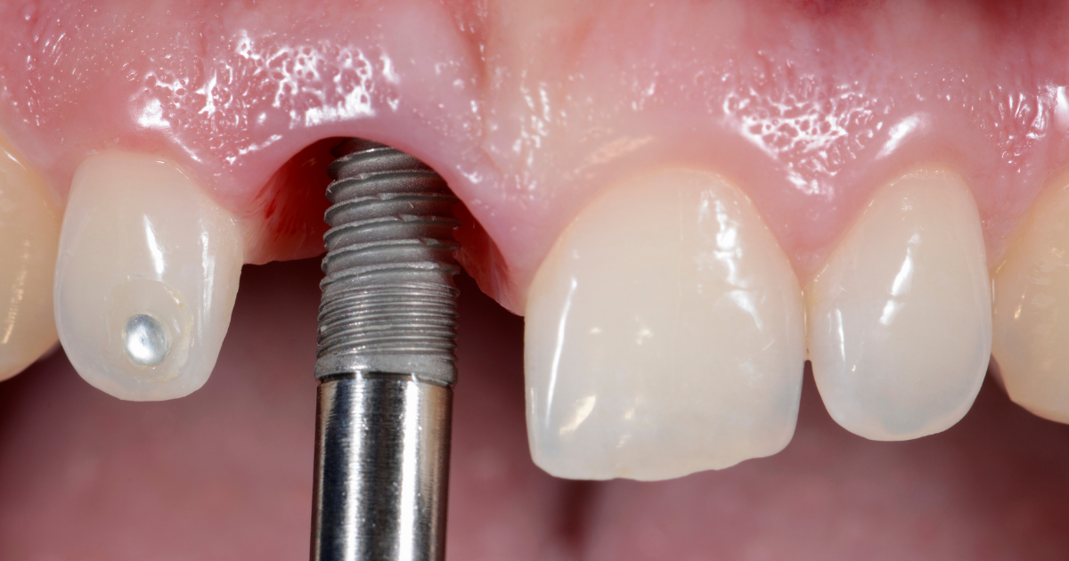 dental implants