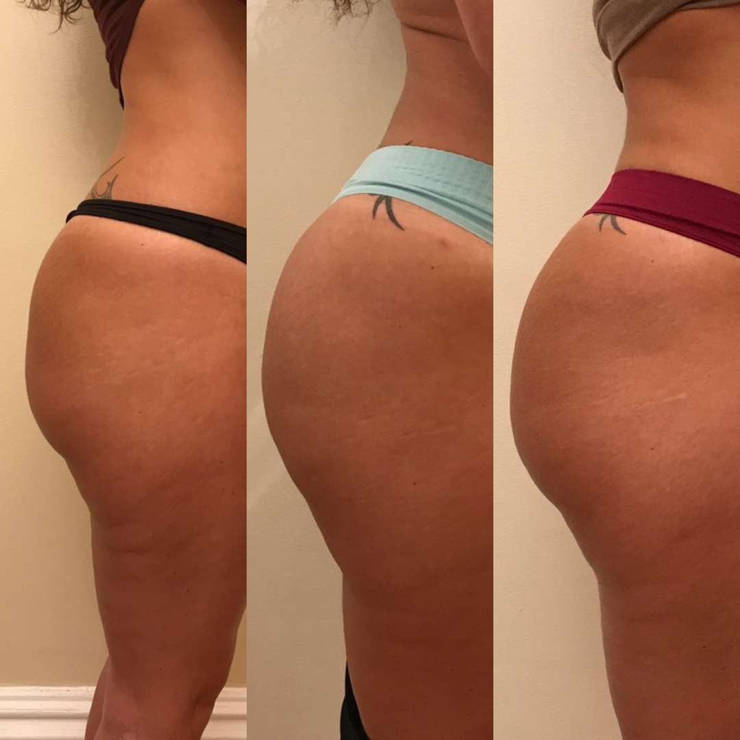 - what is the difference between backside shots and sculptra butt lift (injectable bbl)? - verve cosmetics nyc