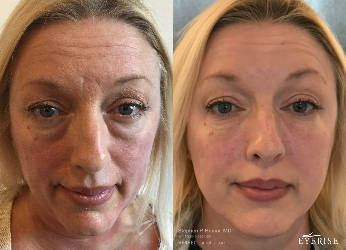 - 5 things you need to look for in botox and dermal filler before and after photo galleries - verve cosmetics nyc