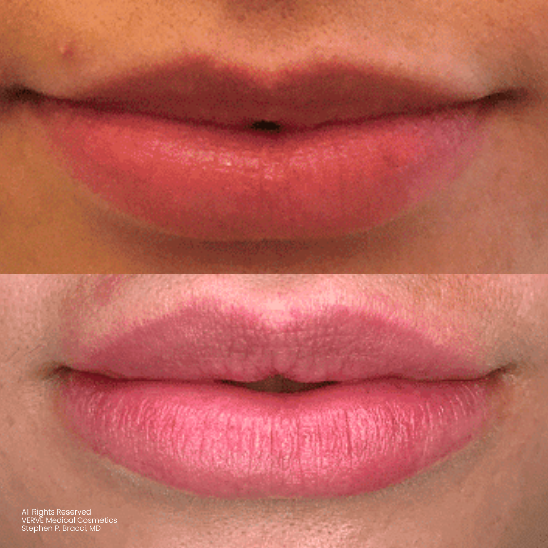 - how long do lip fillers last? - verve cosmetics nyc