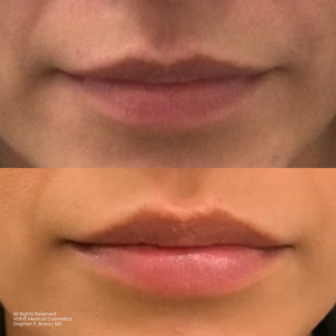 - how long do lip fillers last? - verve cosmetics nyc