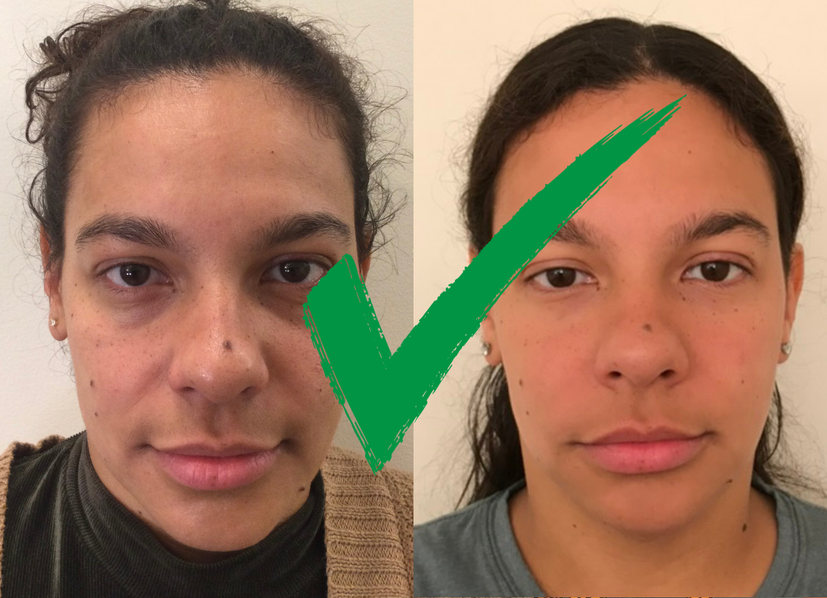- 5 things you need to look for in botox and dermal filler before and after photo galleries - verve cosmetics nyc
