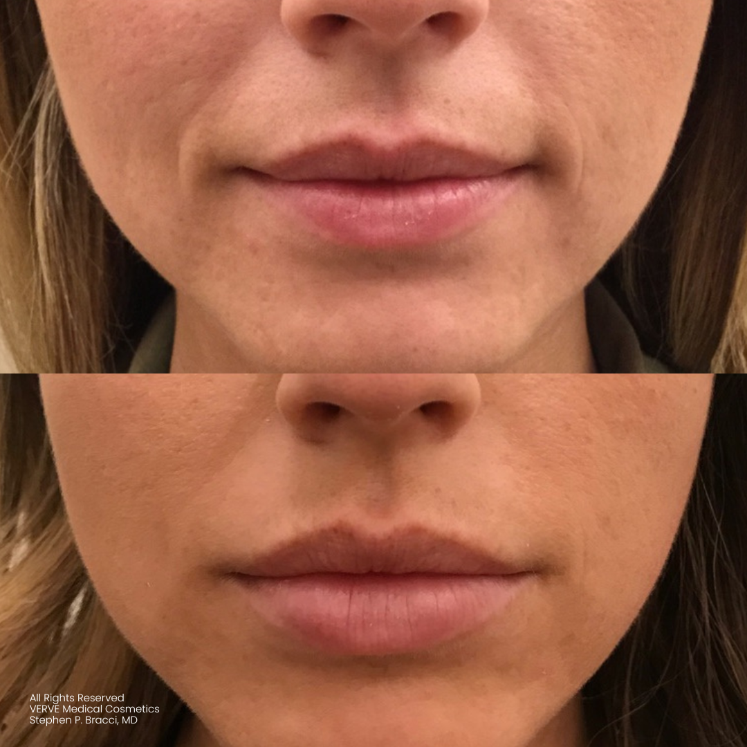 - how long do lip fillers last? - verve cosmetics nyc