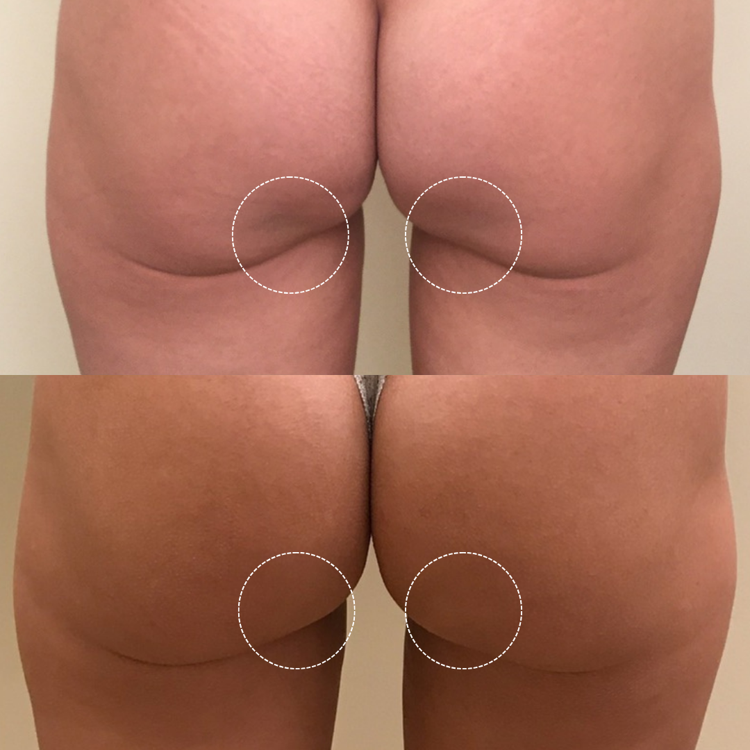 - What is the Difference between Backside Shots and Sculptra Butt Lift (Injectable BBL)? - Verve Cosmetics NYC