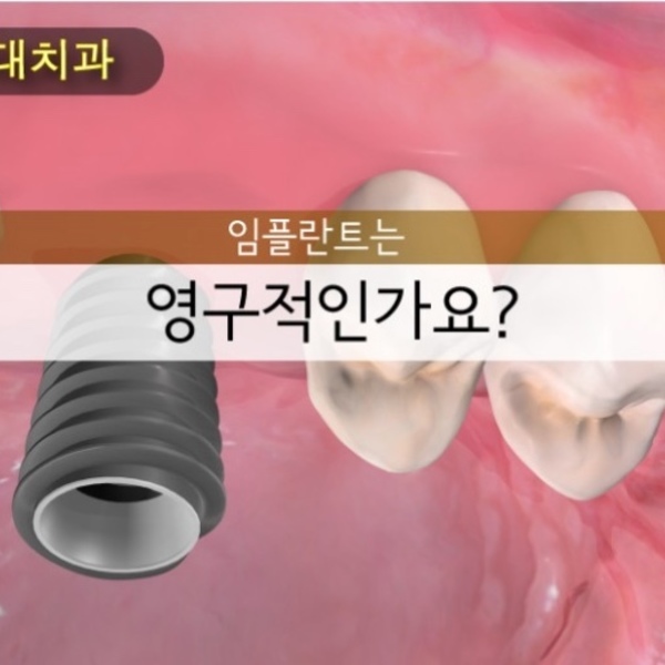 임플란트는-영구적인가요?