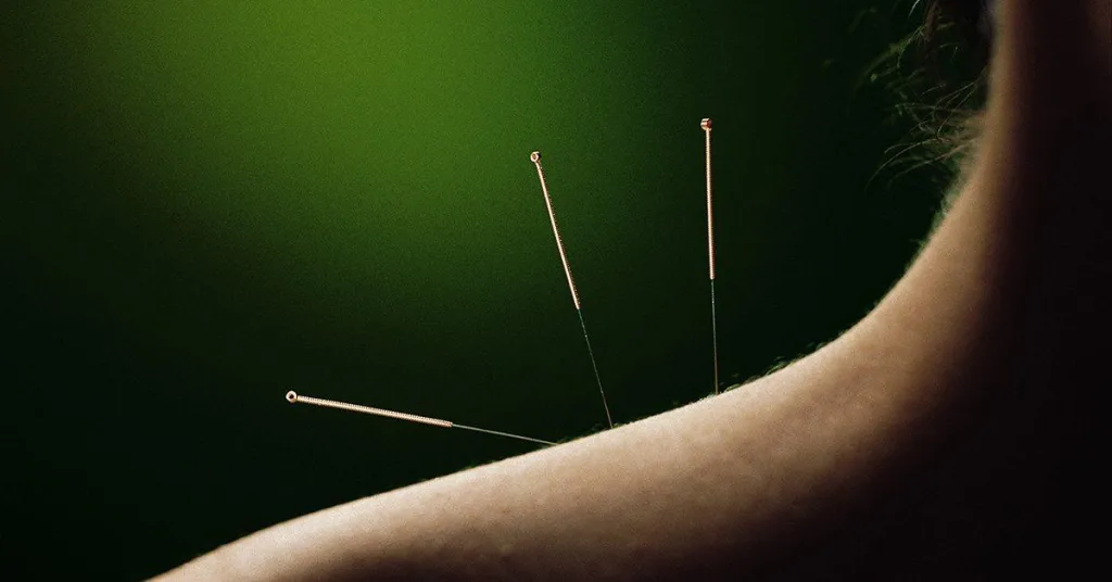 Acupuncture