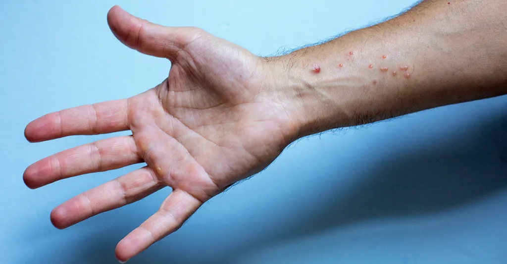 Hand and forearm with Monkeypox