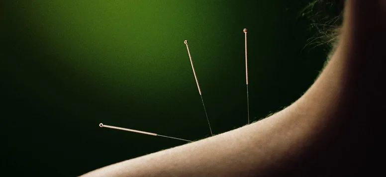 Acupuncture