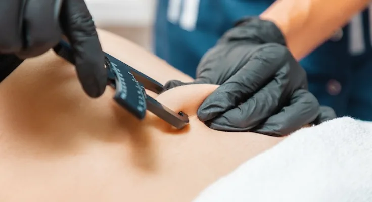 Nurse using calipers and BMI formula to determine patient's body fat