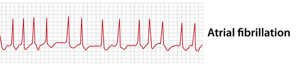 Atrial fibrillation EKG