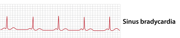 Sinus bradycardia EKG