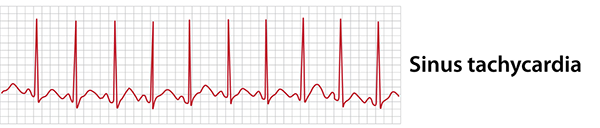 Sinus tachycardia EKG