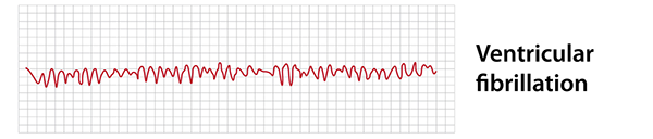 Ventricular fibrillation EKG
