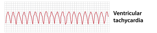 Ventricular tachycardia EKG