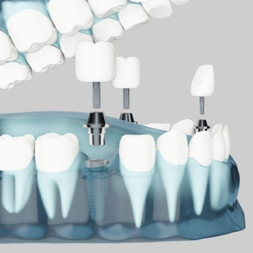 The Facts on Plaque, Cromwell Dentists