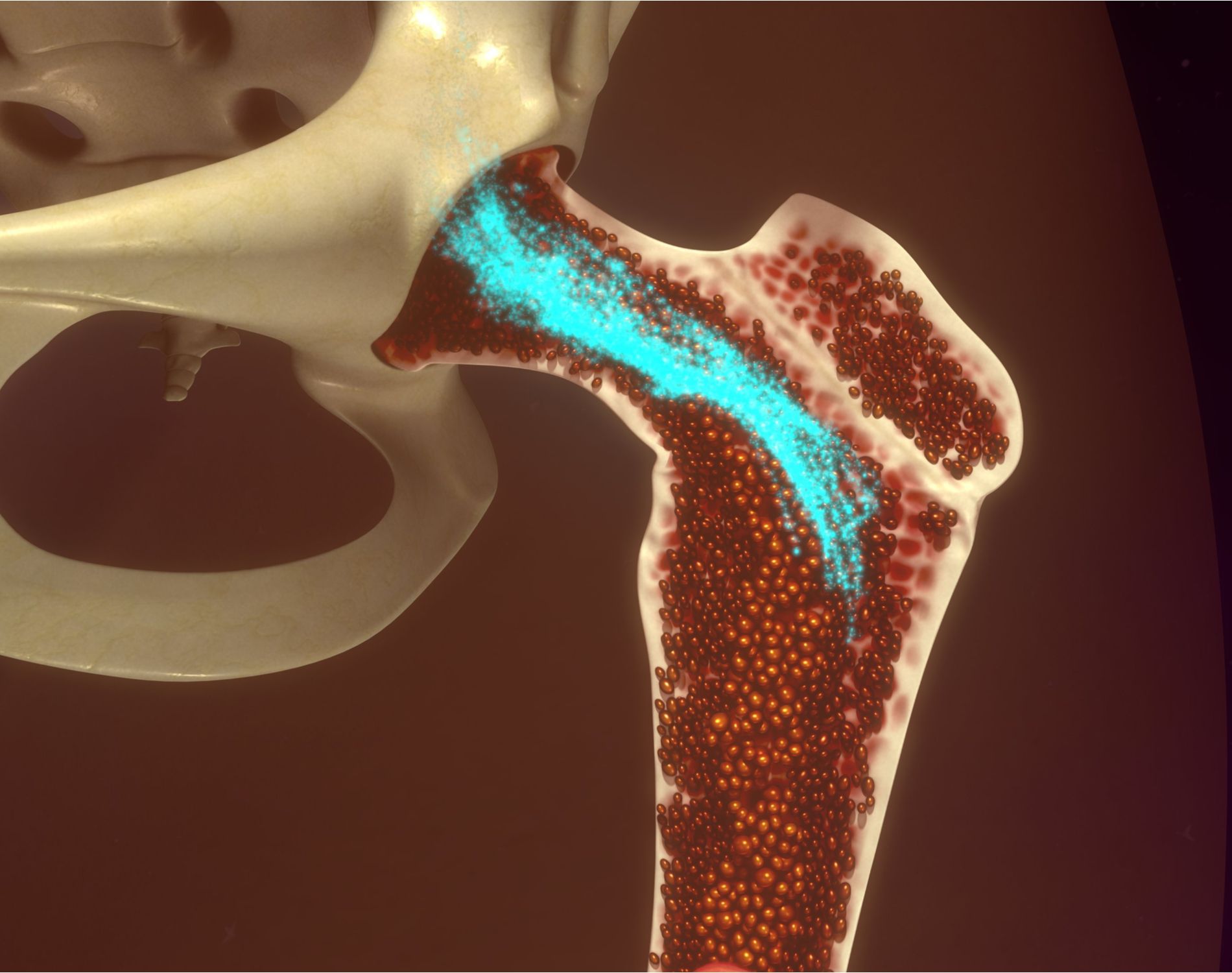 Bone Marrow Microenvironment. The Myeloma Crowd