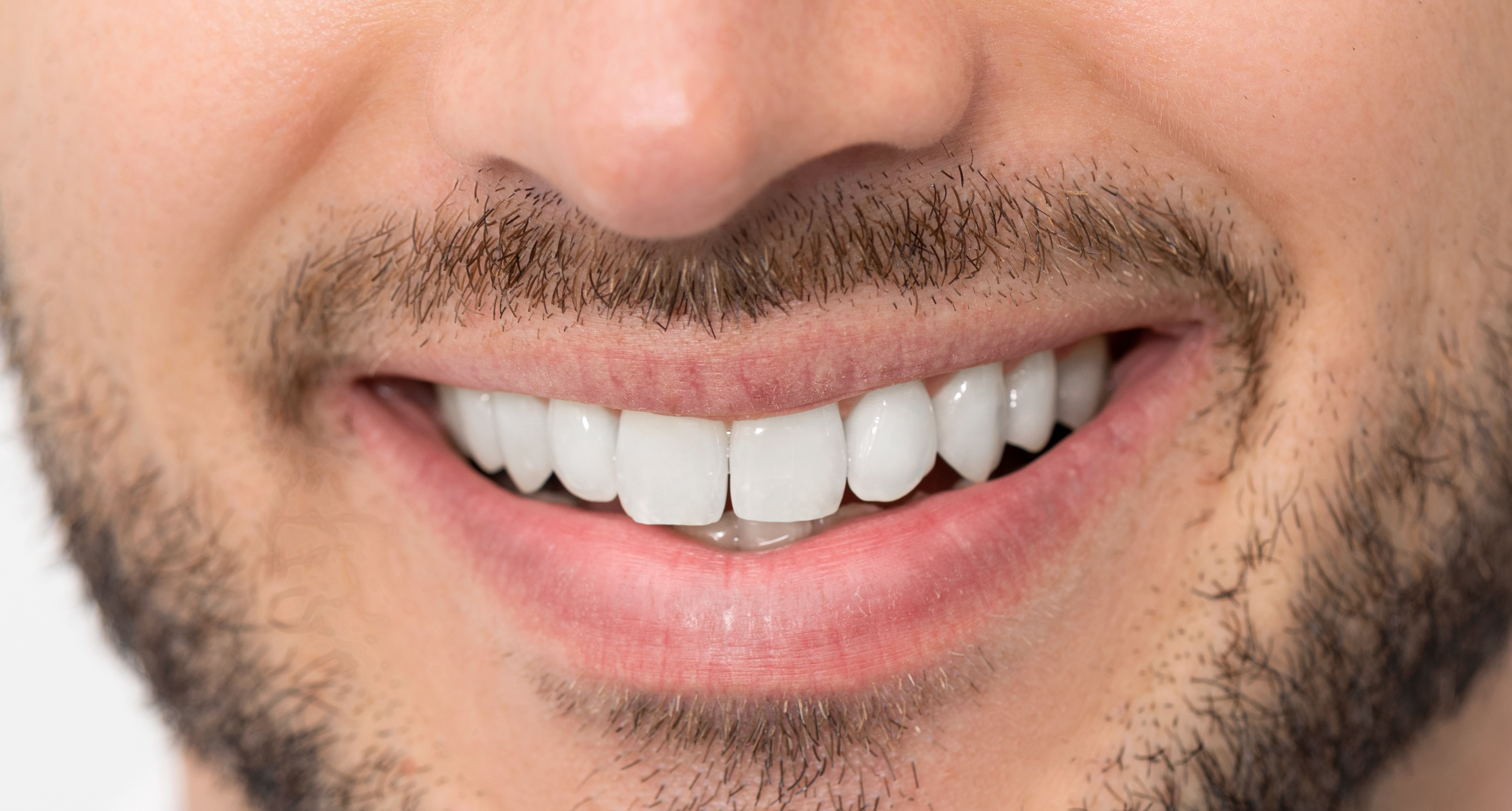 After: Clinical illustration showing potential tooth whitening results of 6-8 shades improvement.