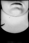 image of neck_brace