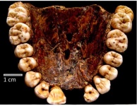 image of tooth #32