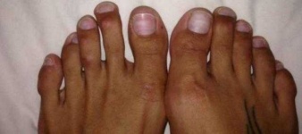 image of toe #2