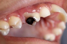 image of tooth #2