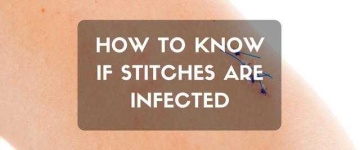 image of stitches