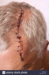 image of stitches