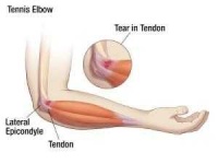 image of elbow #3