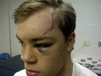 image of stitches