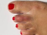 image of toe #1