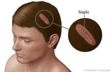 image of stitches