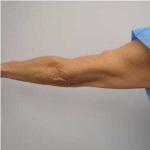 image of arm #6