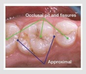 image of tooth #13