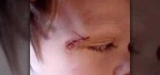 image of stitches