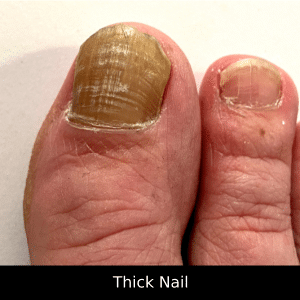 image of nail_disease #0